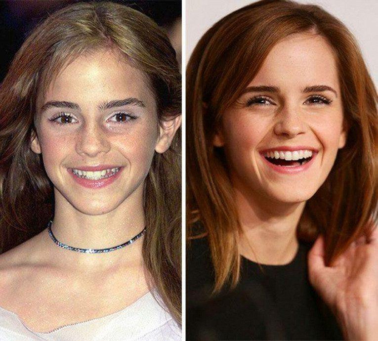 Как плохие зубы звезд превратились в улыбки на миллион: фото до и после6