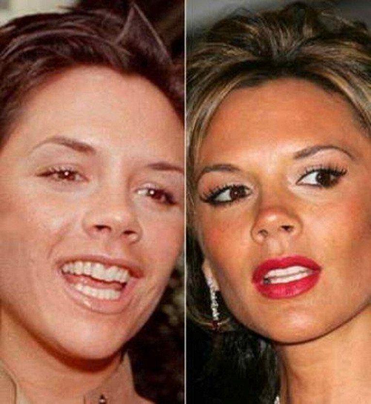 Как плохие зубы звезд превратились в улыбки на миллион: фото до и после1