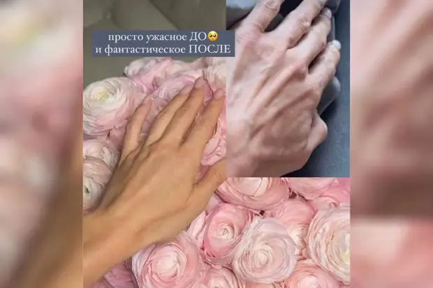 Модель Лена Перминова опубликовала фото рук после инъекций филлерами0