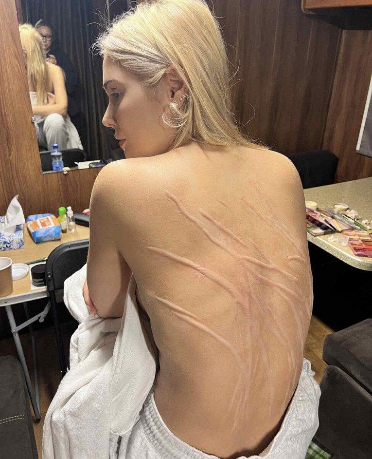 Наталья Рудова показала жуткие шрамы на спине | KPIZ.ru