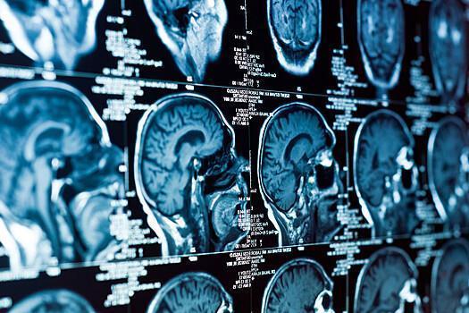 Почему рак мозга не поддается лечению, выяснили ученые