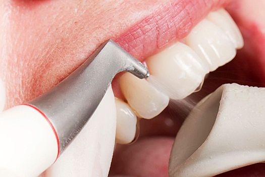 Стоматолог: отказ от профессиональной гигиены зубов увеличивает риск развития пародонтита