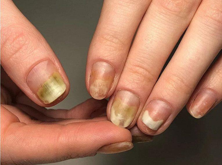 Жуткие последствия гель-лака для ногтей1