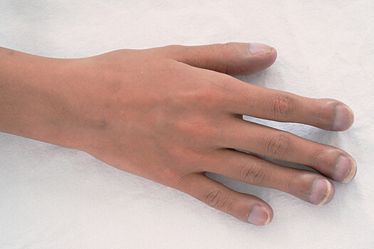 Какая форма ногтей на руках может указывать на болезнь сердца