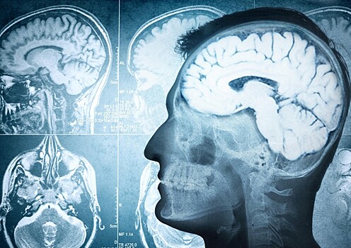 Датские ученые обнаружили защиту от болезни Альцгеймера в мозге человека