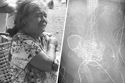 The Sun: в Бразилии 81-летняя женщина вынашивала ребенка 56 лет1