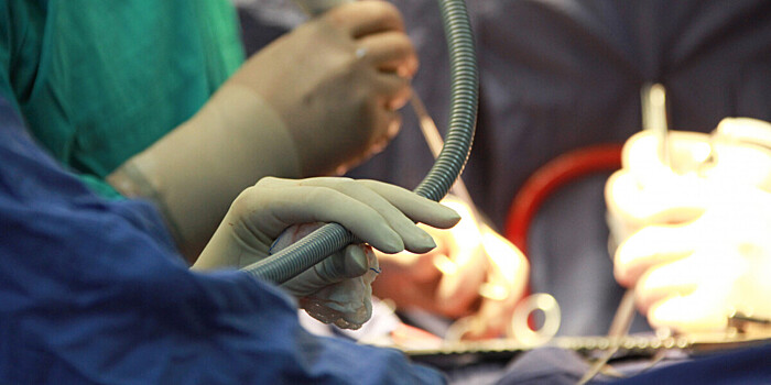 Хирурги впервые пересадили сердечный насос и почку свиньи живому человеку