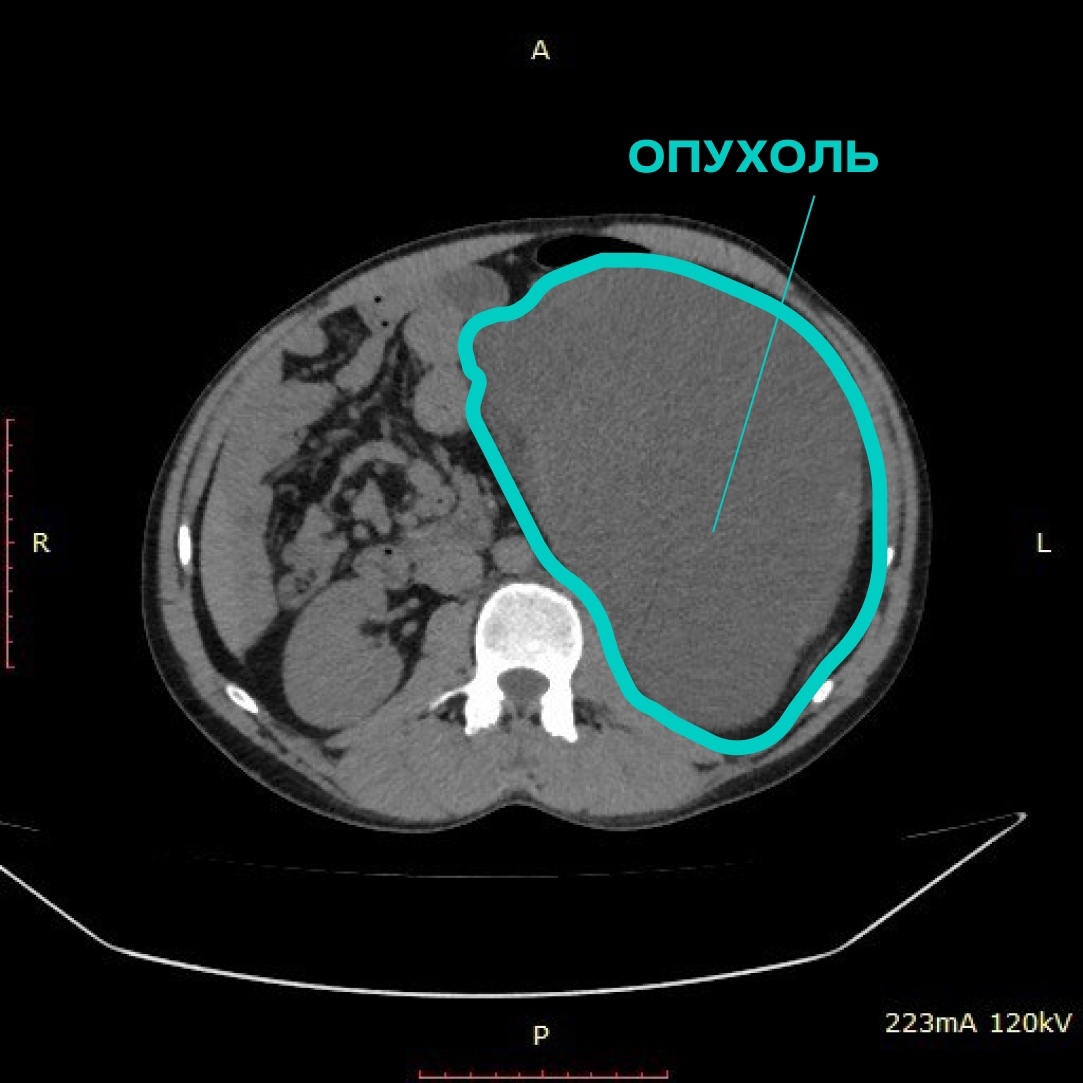 Россиянин вырастил гигантскую опухоль в животе, которая сдвинула его органы1