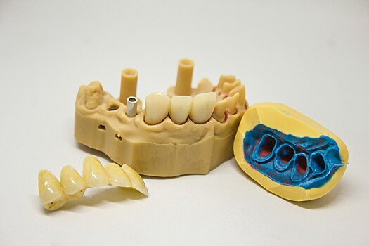 Разработана новая технология производства зубных имплантов
