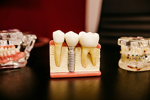 Стоматолог рассказал, что делать при проблеме с зубным имплантом