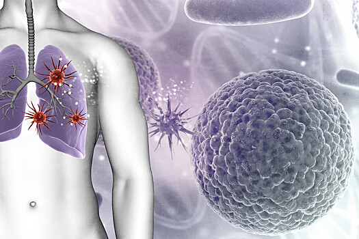 Туберкулез повышает риск развития нескольких видов рака