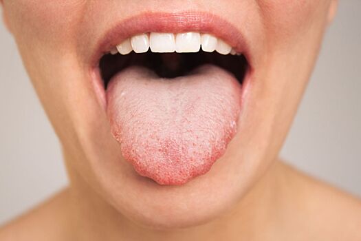 «Зубчатый» язык может быть признаком опасного заболевания