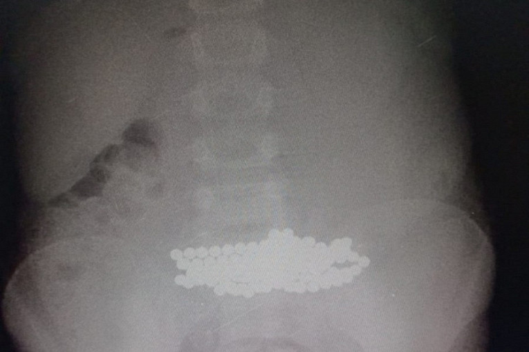 Врачи Ленобласти спасли ребенка, проглотившего более ста магнитов1
