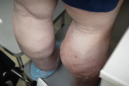 Челябинские врачи прооперировали пациента со слоновьими ногами