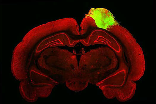 Нейробиологи заявили, что воспаление мозга помогает создавать долговременные воспоминания