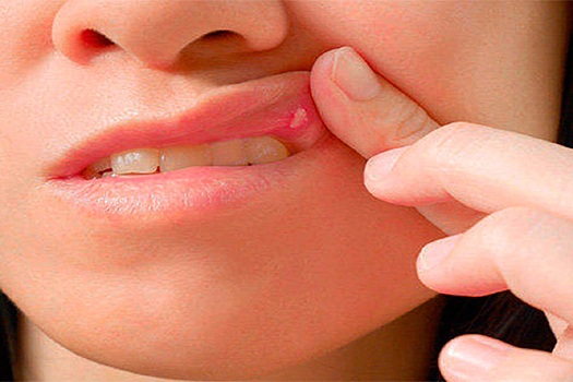 Стоматолог указала на первые симптомы рака полости рта