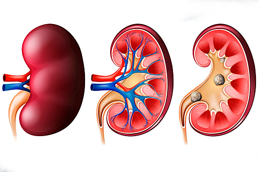 Уролог объяснил, помогает ли обильное питье не образовываться камням в почках