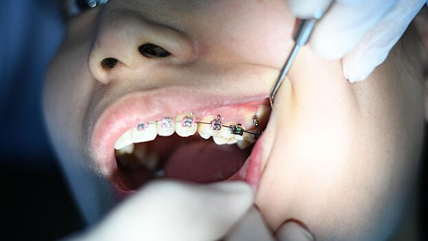 Стоматолог назвала главные показания для установки брекетов