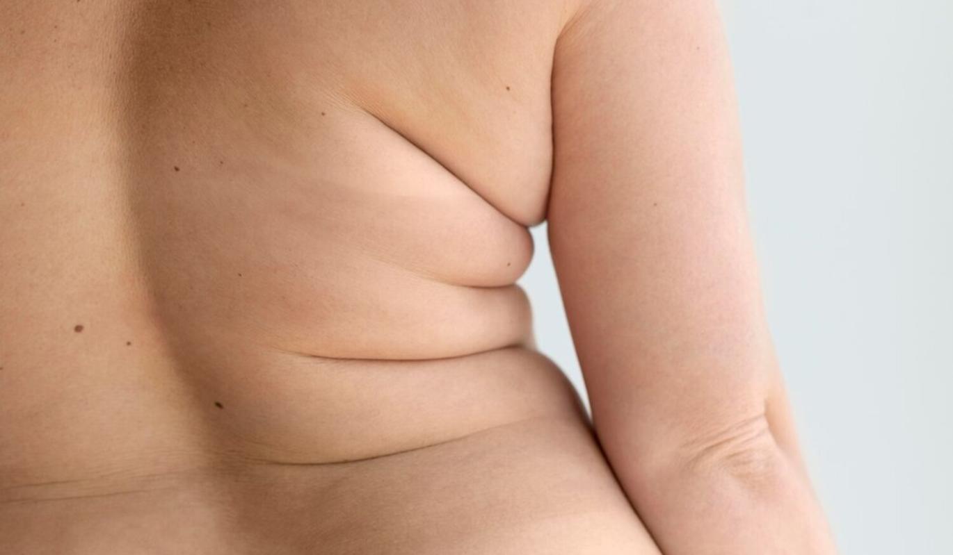 Ожирение: чем может быть опасно ушивание желудка для похудения
