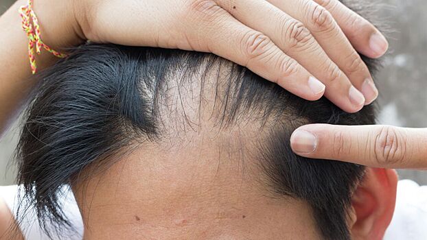 Ученый рассказал, по какой причине могут выпадать волосы