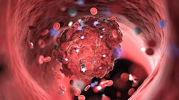 Как предотвратить появление тромбоза и вовремя его обнаружить