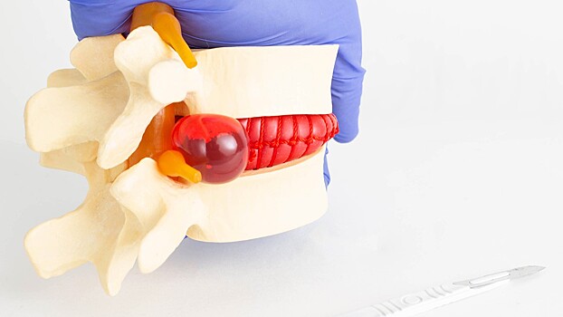 Найдены новые генетические факторы риска межпозвоночной грыжи