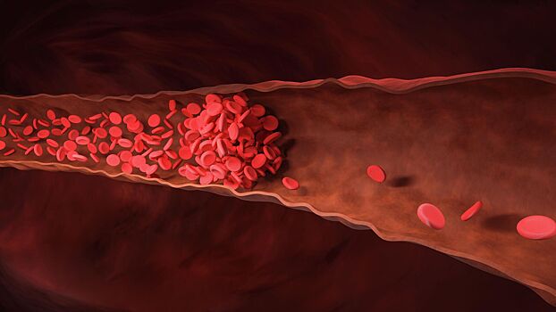Волгоградские ученые сделали важный шаг в борьбе с тромбозом
